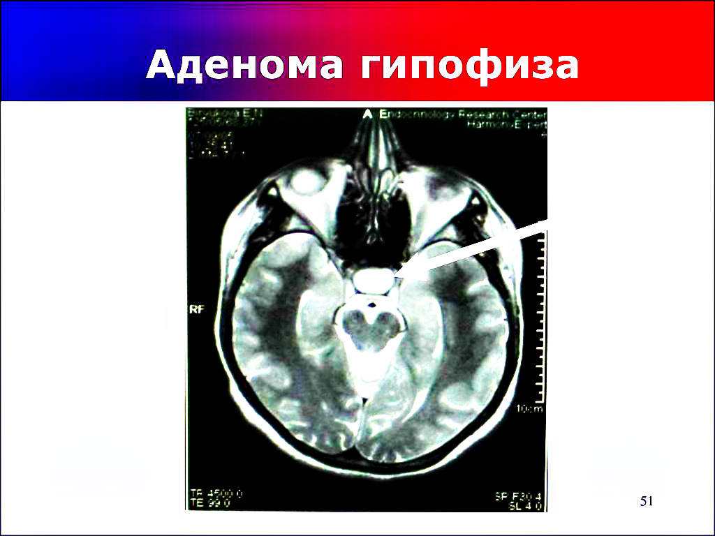 Микроаденома гипофиза. Аденома гипофиза головного мозга мкб 10. Микроаденома мкб 10. Макроаденома гипофиза мкб10.